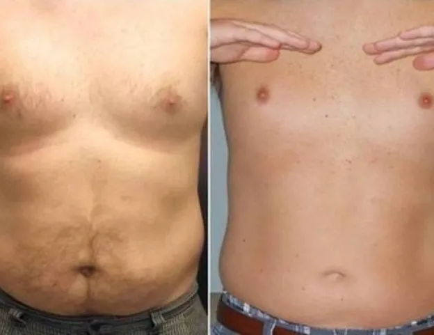 weightloss before and after