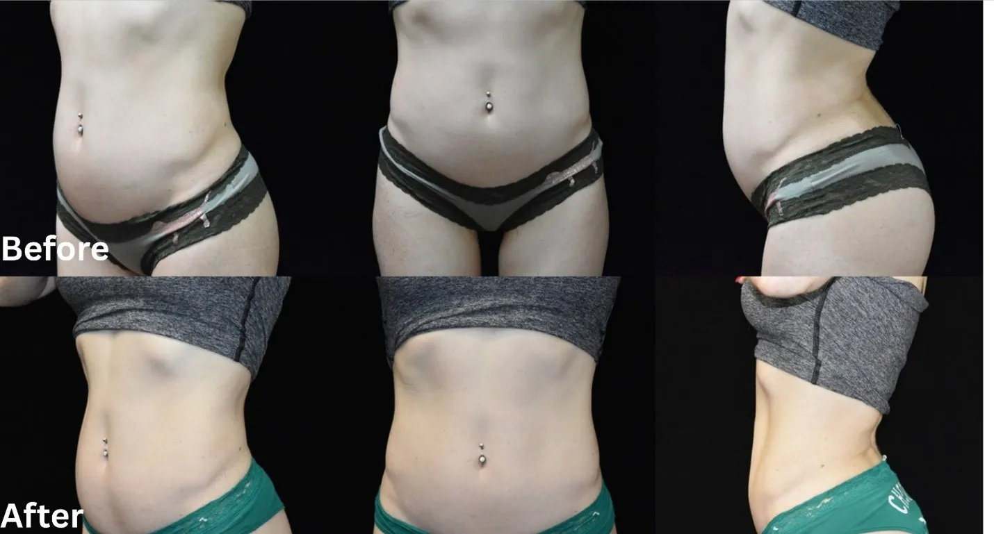 Before and after UltraSlim red light therapy results in Amarillo