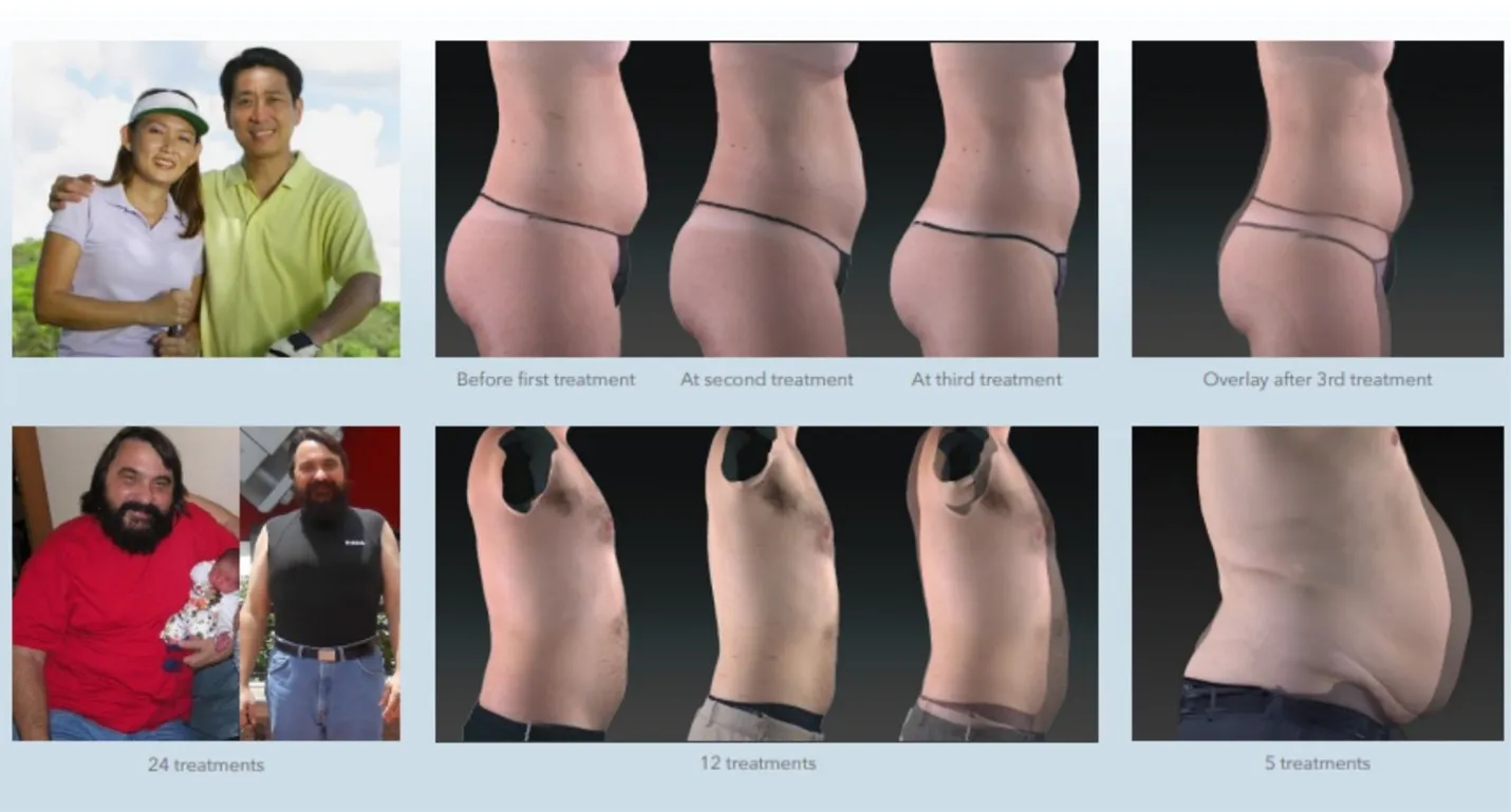 light-based body contouring in Amarillo
